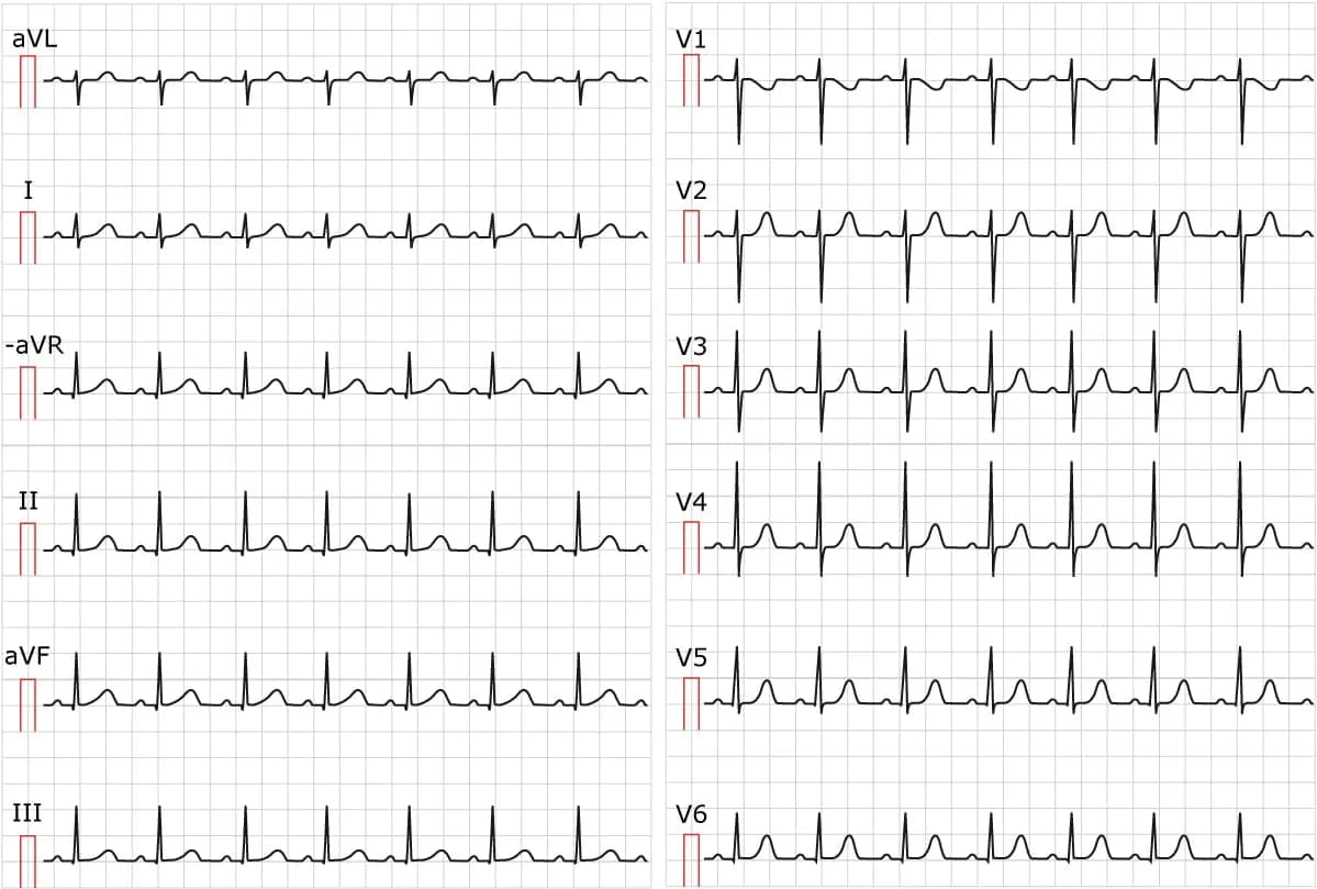 Figure 1. ECG showing sinus tachycardia. Paper speed 25 mm/s. Calculate the heart rate by dividing 300 by the number of large boxes between R-waves. There are approximately 3 large boxes between the R-waves; 300/3 equals 100 beats per minute.