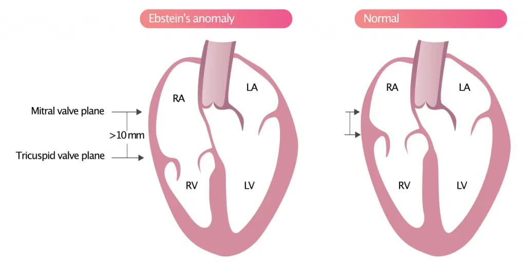 Ebstein's anomaly.