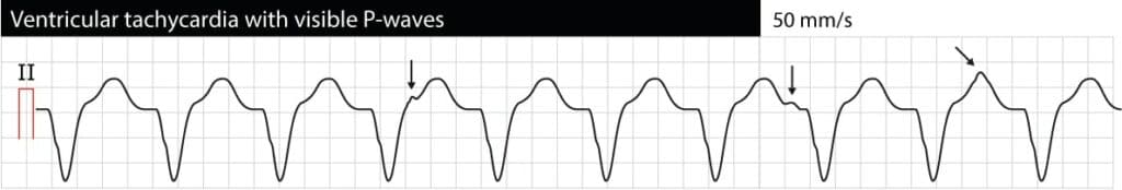 Figure 1. Monomorphic ventricular tachycardia (VT, VTach). P-waves are visible but they do not have any relation to the QRS complexes. This situation is referred to as "AV dissociation" and indicates that atrial and ventricular activity and independent. AV dissociation confirms that the arrhythmia is ventricular tachycardia. However, AV dissociation is frequently difficult to spot.