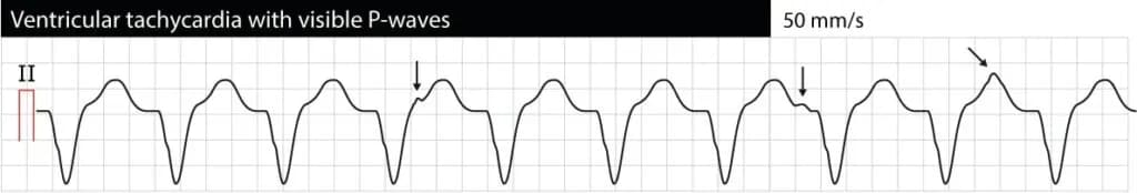 Figure 1. Monomorphic ventricular tachycardia (VT, VTach). P-waves are visible but they do not have any relation to the QRS complexes. This situation is referred to as "AV dissociation" and indicates that atrial and ventricular activity and independent. AV dissociation confirms that the arrhythmia is ventricular tachycardia. However, AV dissociation is frequently difficult to spot.