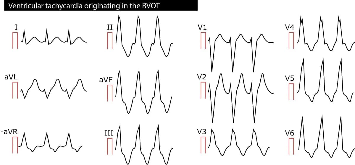 Figure 2. Ventricular tachycardia (VT) originating in the right ventricular outflow tract (RVOT).
