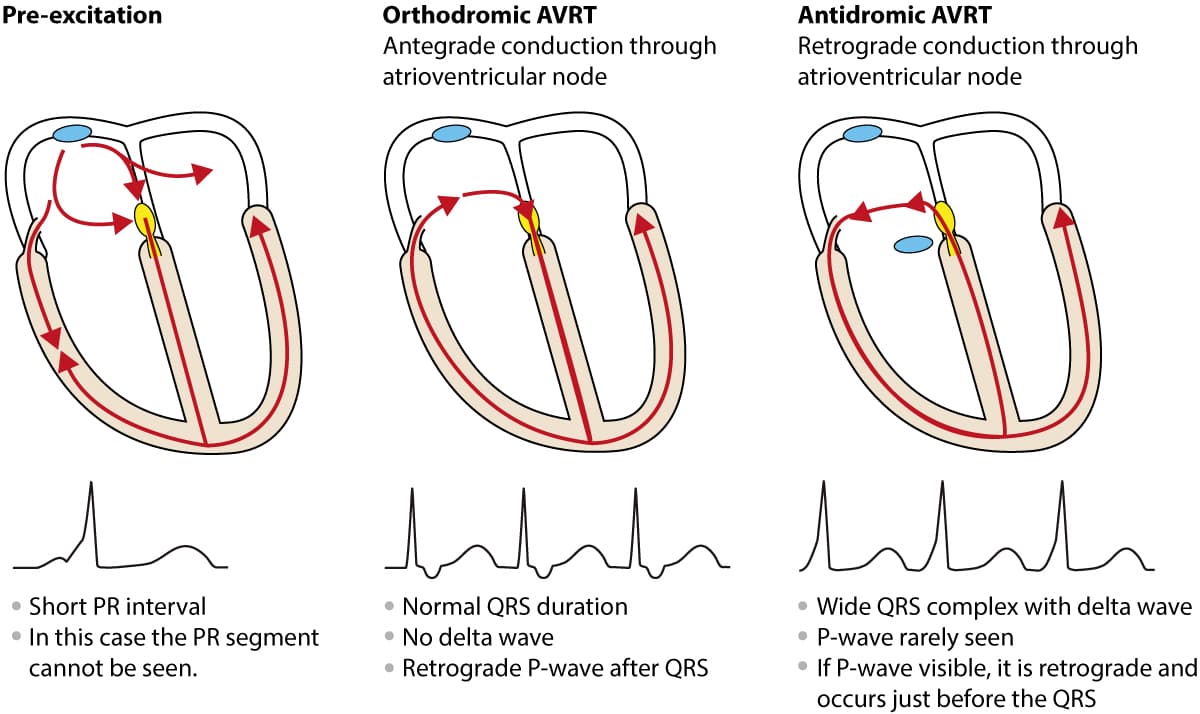 Figure 3. Antidromic and orthdromic AVRT.