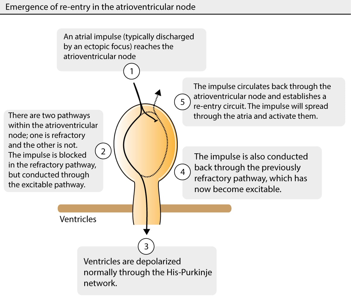 Figure 1. Mechanism leading to AVNRT.