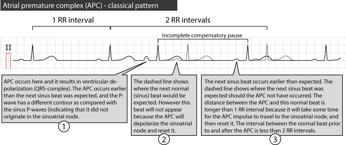 Figure 2. Premature atrial beat with incomplete compensatory pause.