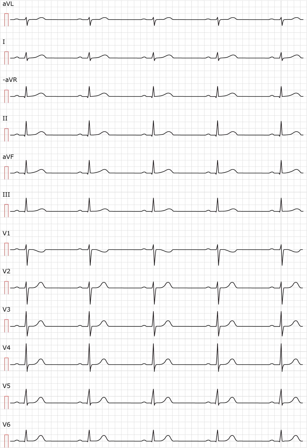 Figure 1. Sinus rhythm. Paperspeed 50 mm/s.