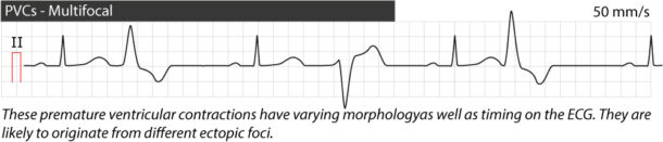 Premature ventricular contractions (premature ventricular complex ...
