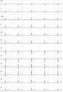 Sinus rhythm: physiology, ECG criteria & clinical implications