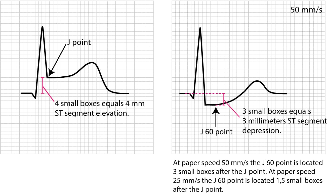 Figure 14. Example of measuring ST-deviation.