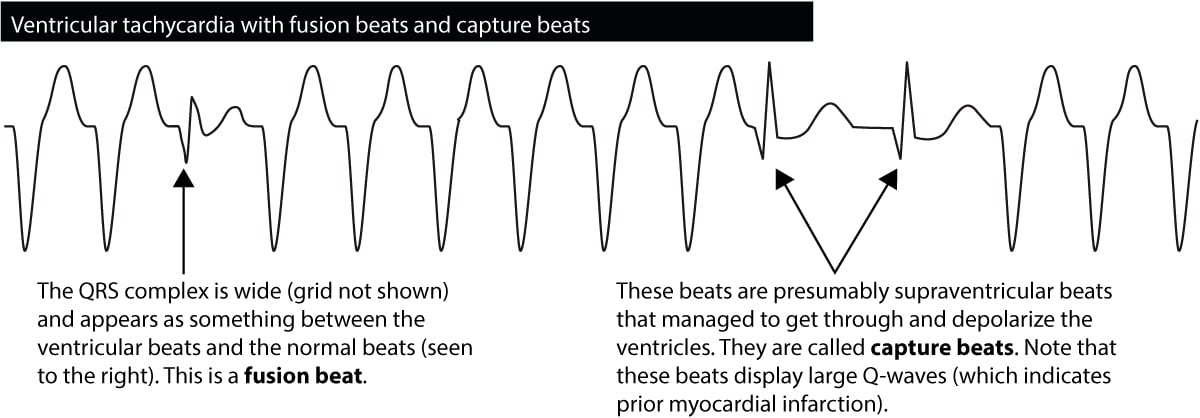 Figure 6. Capture beats and fusion beats in ventricular tachycardia.