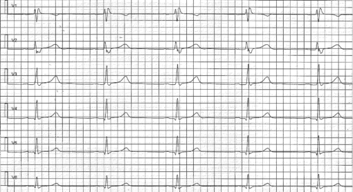 Early repolarization pattern on ECG and early repolarization syndrome
