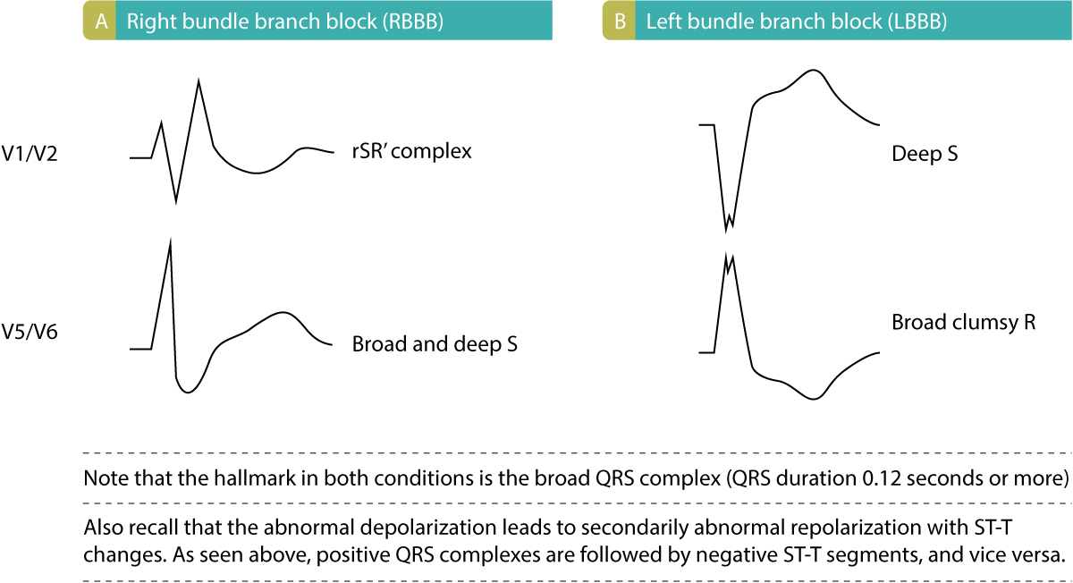 Figure 2. Characteristics of bundle branch blocks. (A): ECG features of right bundle branch block (RBBB). (B): ECG features of left bundle branch block (LBBB).