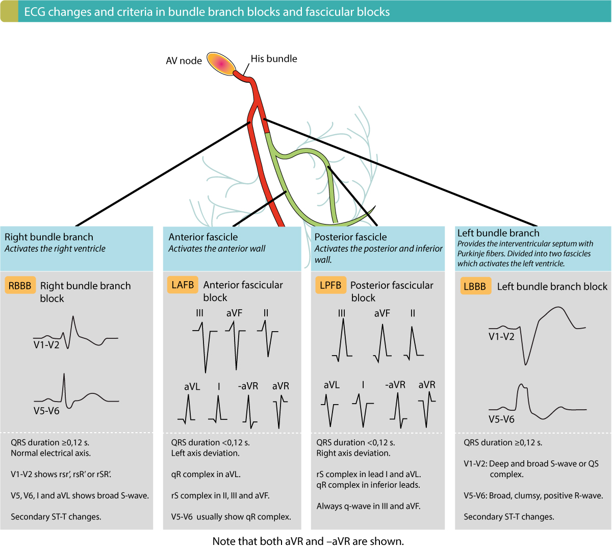 Figure 3. Overview of criteria and ECG changes in bundle branch blocks and fascicular blocks. All these intraventricular conduction delays are common and therefore important to recognize.