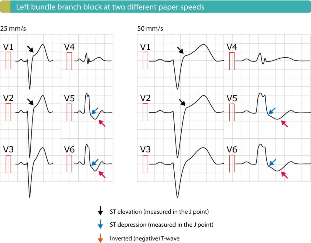 Left bundle branch block (LBBB): ECG criteria, causes, management