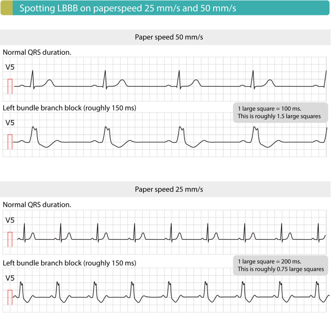 Left bundle branch block (LBBB): ECG criteria, causes, management