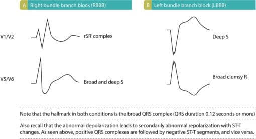 Difference between LBBB and RBBB – The Cardiovascular