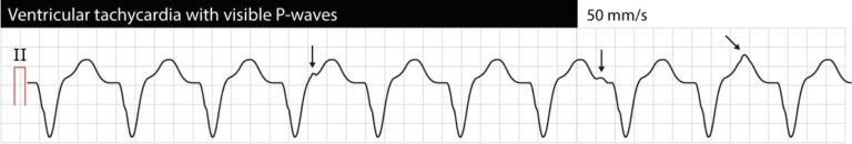 Ventricular tachycardia (VT): ECG criteria, causes, classification ...