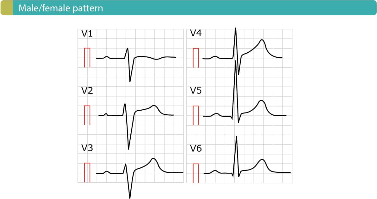Figure 3. Male/female pattern. Also called "Normal ST segment elevation".