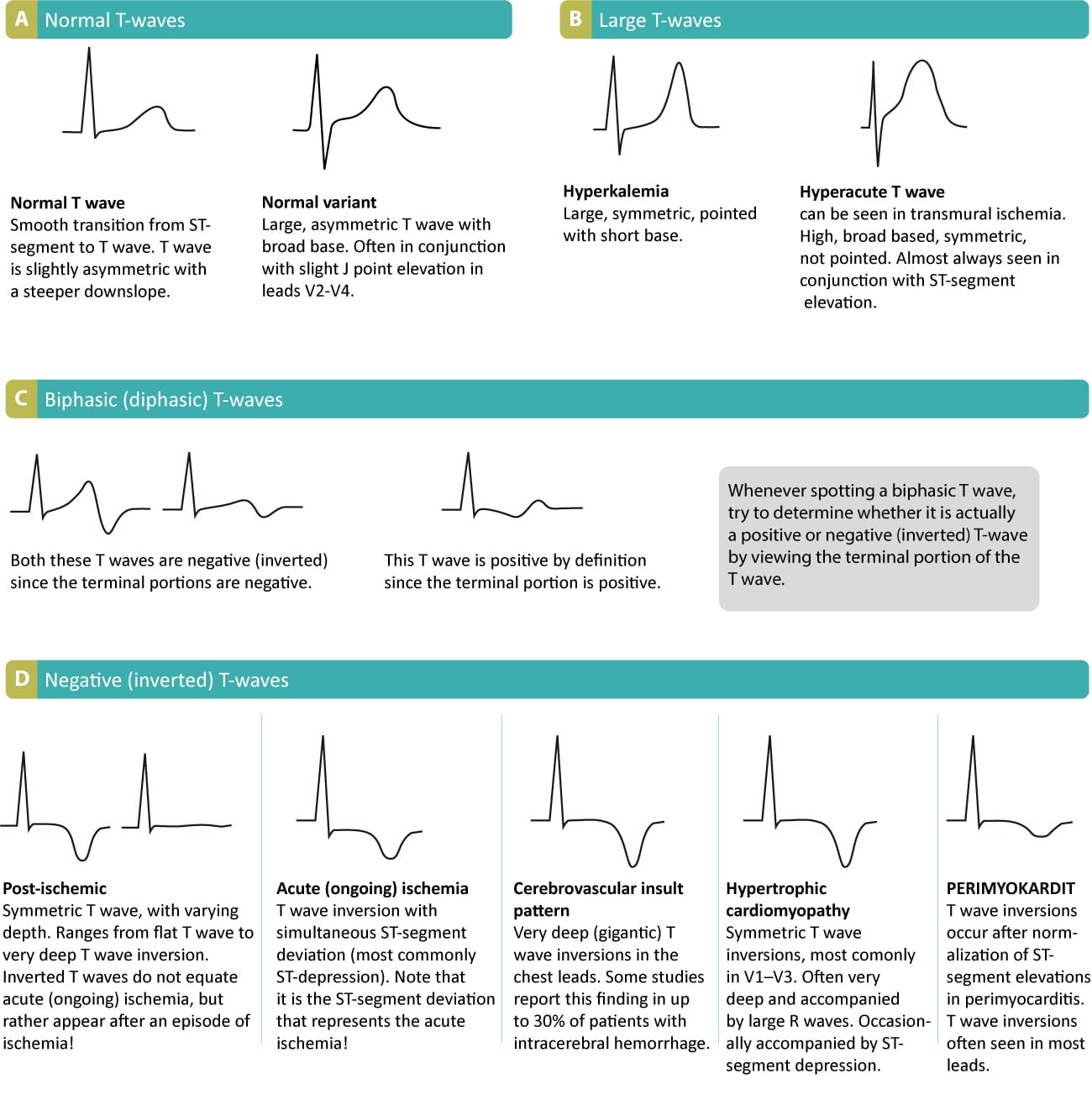 Figure 1. Various T-wave abnormalities.