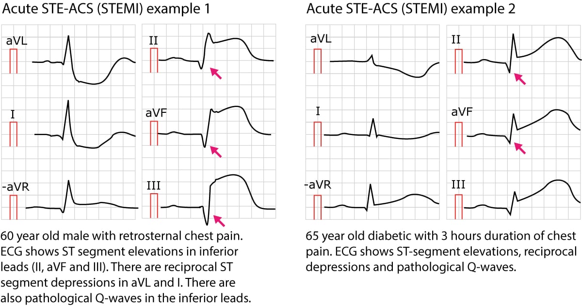 Figure 3. Examples of STE-ACS (STEMI).