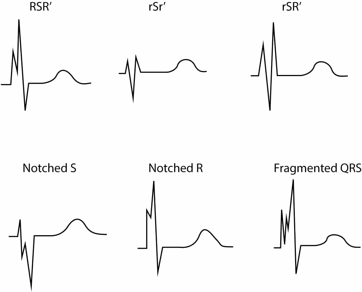 Fragmented QRS complex.