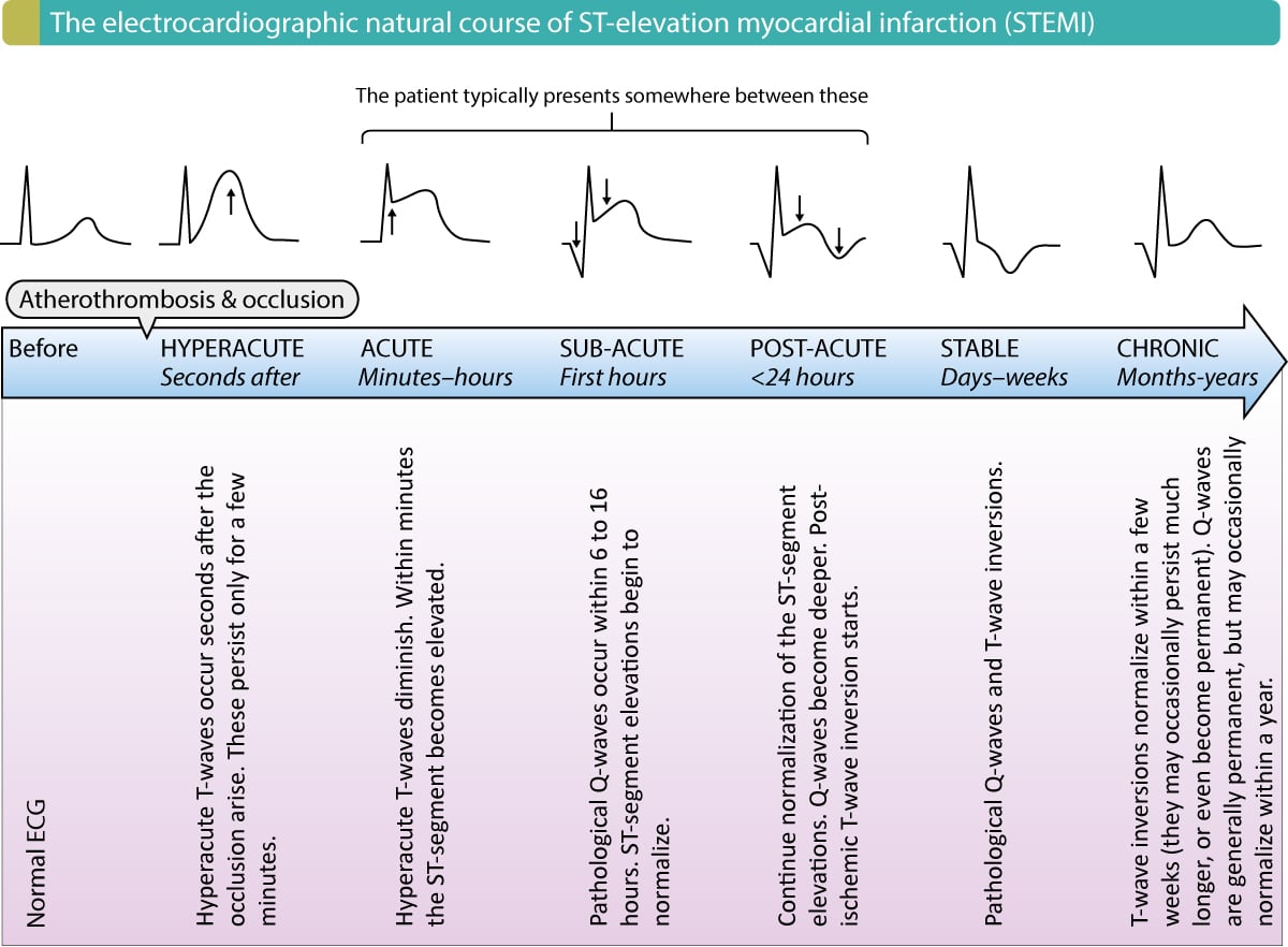 Figure 1. Normalization of ST-segment elevation and T-wave changes during STE-ACS/STEMI.