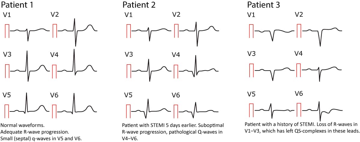 Figur 28. Normal and pathological Q-waves.