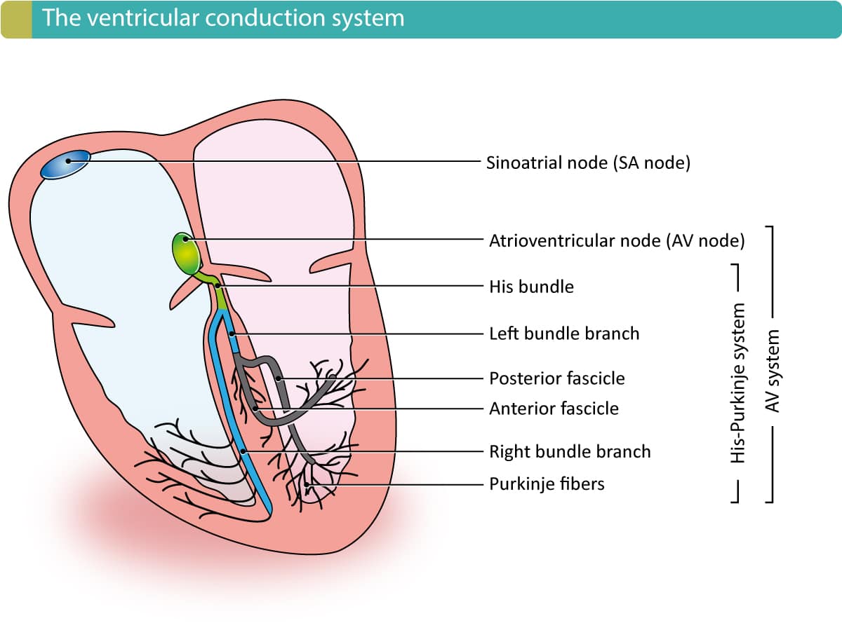 Figure 1. The electrical conduction system of the heart, with emphasis on the ventricles. The sinoatrial (SA) node and atrioventricular (AV) node are located in the atria (they are not part of the ventricular conduction system). The AV node continues in the bundle of His, which branches into the right and left bundle branch. The left bundle branch is then divided into an anterior and posterior fascicle. The right bundle branch and the fascicles then branch further into the fine Purkinje network which sprouts out to the entire myocardium. Note that the ventricular conduction system is the His-Purkinje system.
