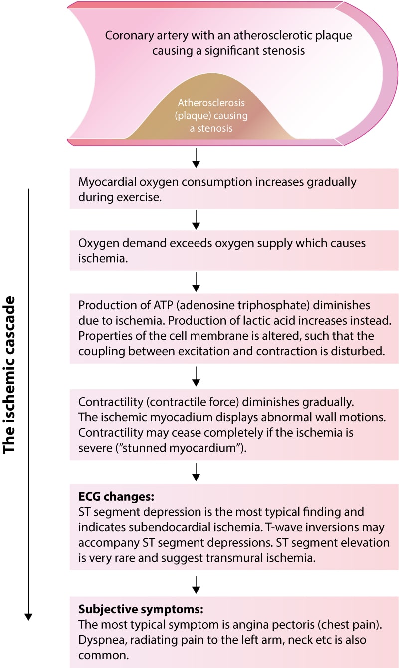 Figure 2. The ischemic cascade illustrates the course from ischemia to ECG changes and clinical symptoms. As illustrated, clinical symptoms (e.g chest pain) are the last events during an ischemic episode. It follows that myocardial ischemia may be present even in the absence of clinical symptoms. Moreover, the ECG detects more ischemic episodes than the patient reports.
