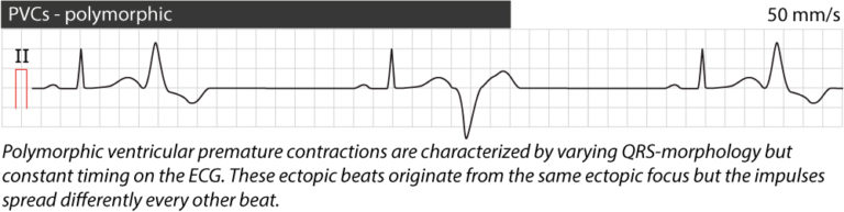 Premature ventricular contractions (premature ventricular complex ...