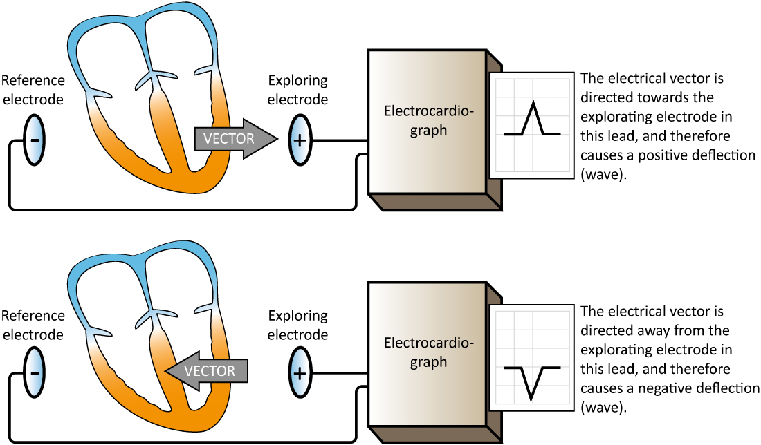 Figure 16. The electrocardiograph generates an ECG lead by comparing the electrical potential difference in two points in space. In the simplest leads these two points are two electrodes (illustrated in this figure). One electrode serves as exploring electrode (positive) and the other as the reference electrode. The electrocardiograph is constructed such that an electrical current traveling towards the exploring electrode yields a positive deflection, and vice versa.