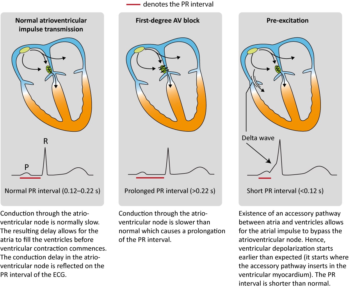 Figure 4. Impulse transmission from the atria to the ventricles. The PR interval reflects whether the impulse transmission through the AV-node is normal (first panel), abnormally slow (second panel) or bypassed (third panel).