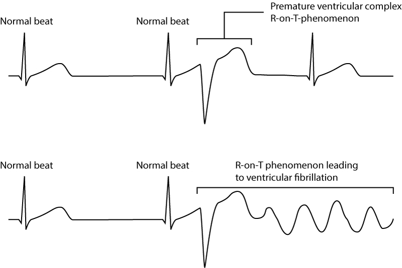 Figure 9. R-on-T phenomenon