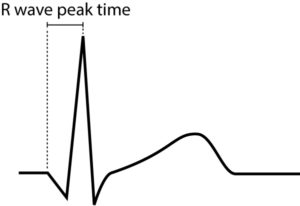 The QRS complex: ECG features of the Q-wave, R-wave, S-wave & duration