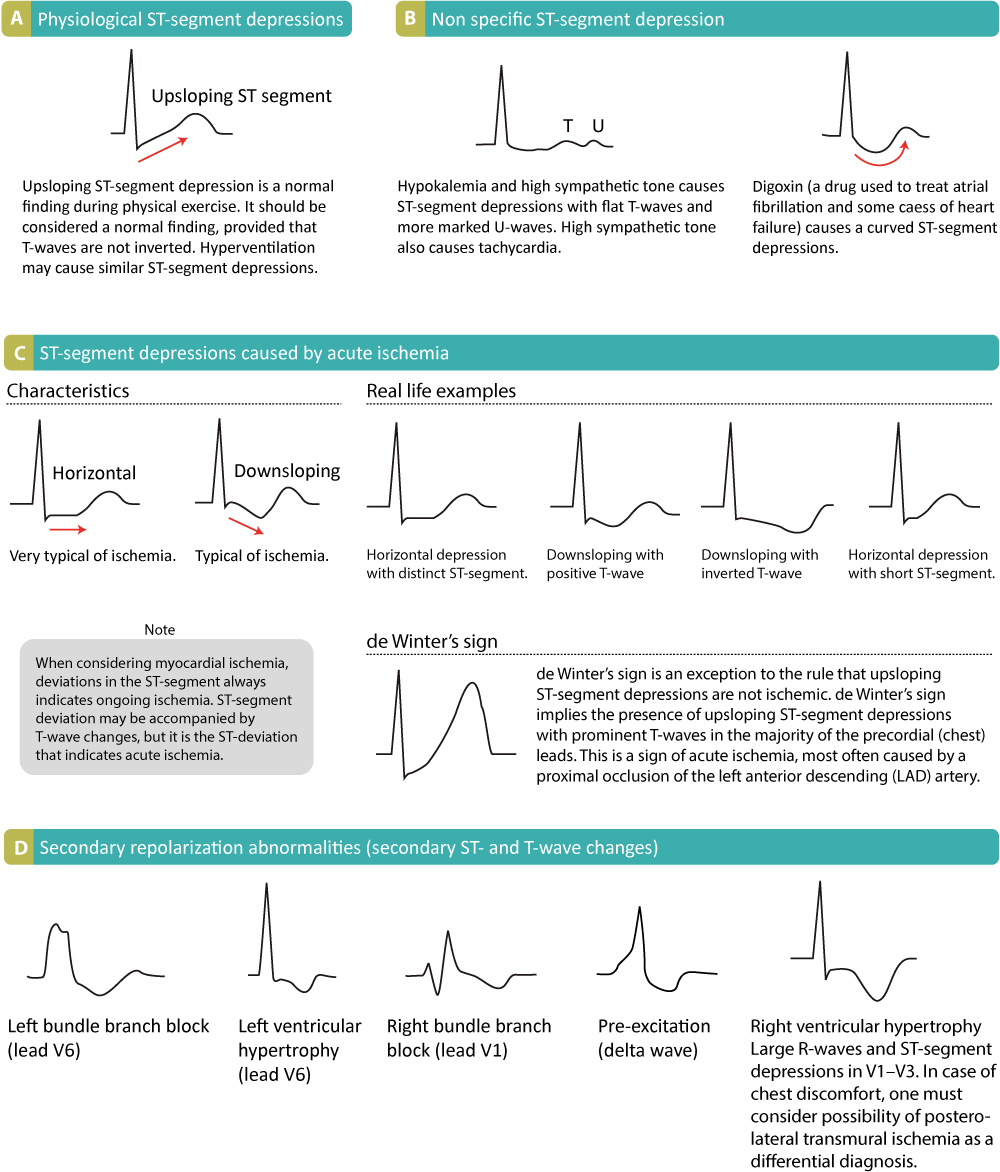 Figure 15. Various causes of ST segment depressions and their appearance.