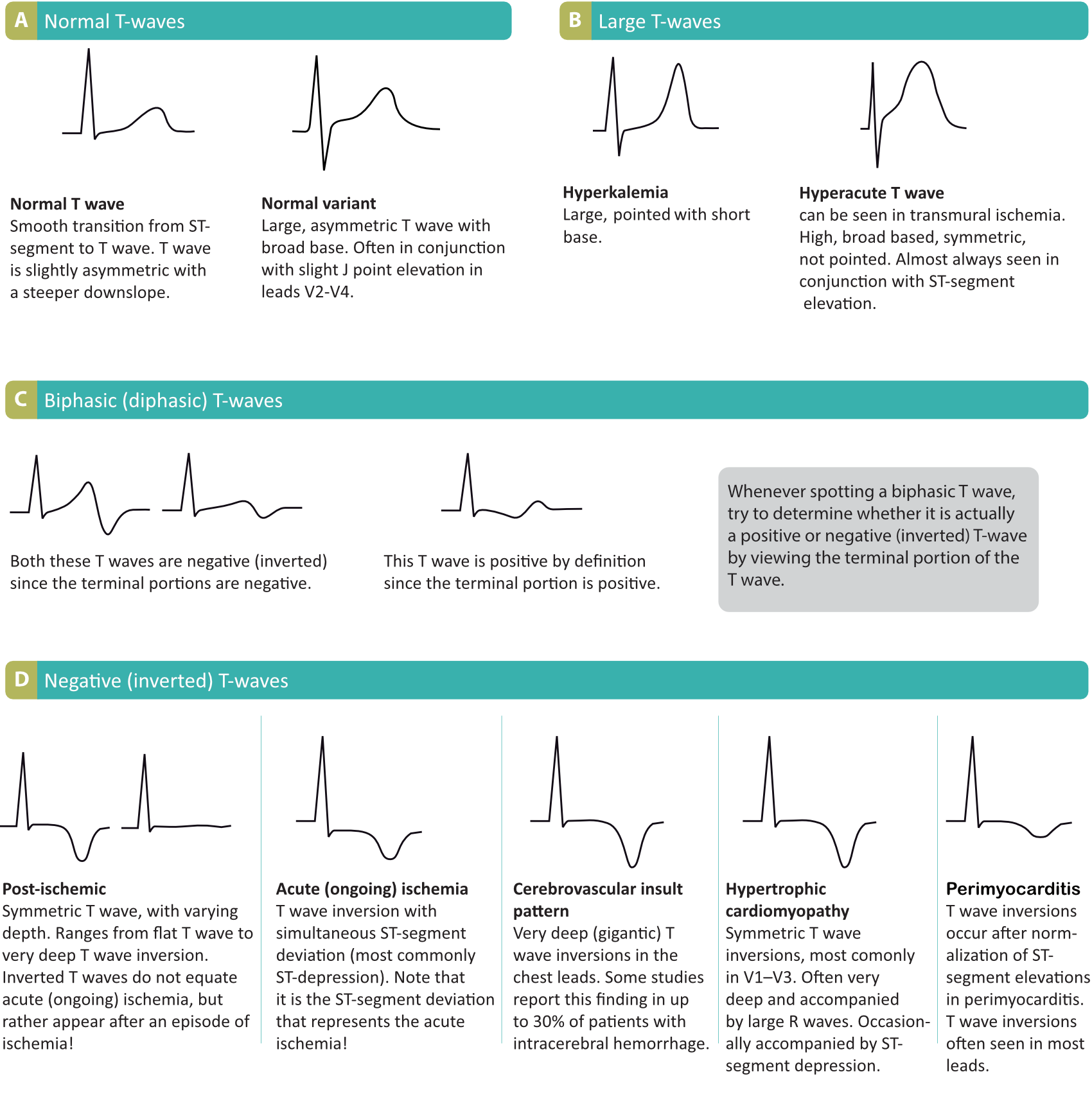 Figure 18. Normal and pathological T-waves.