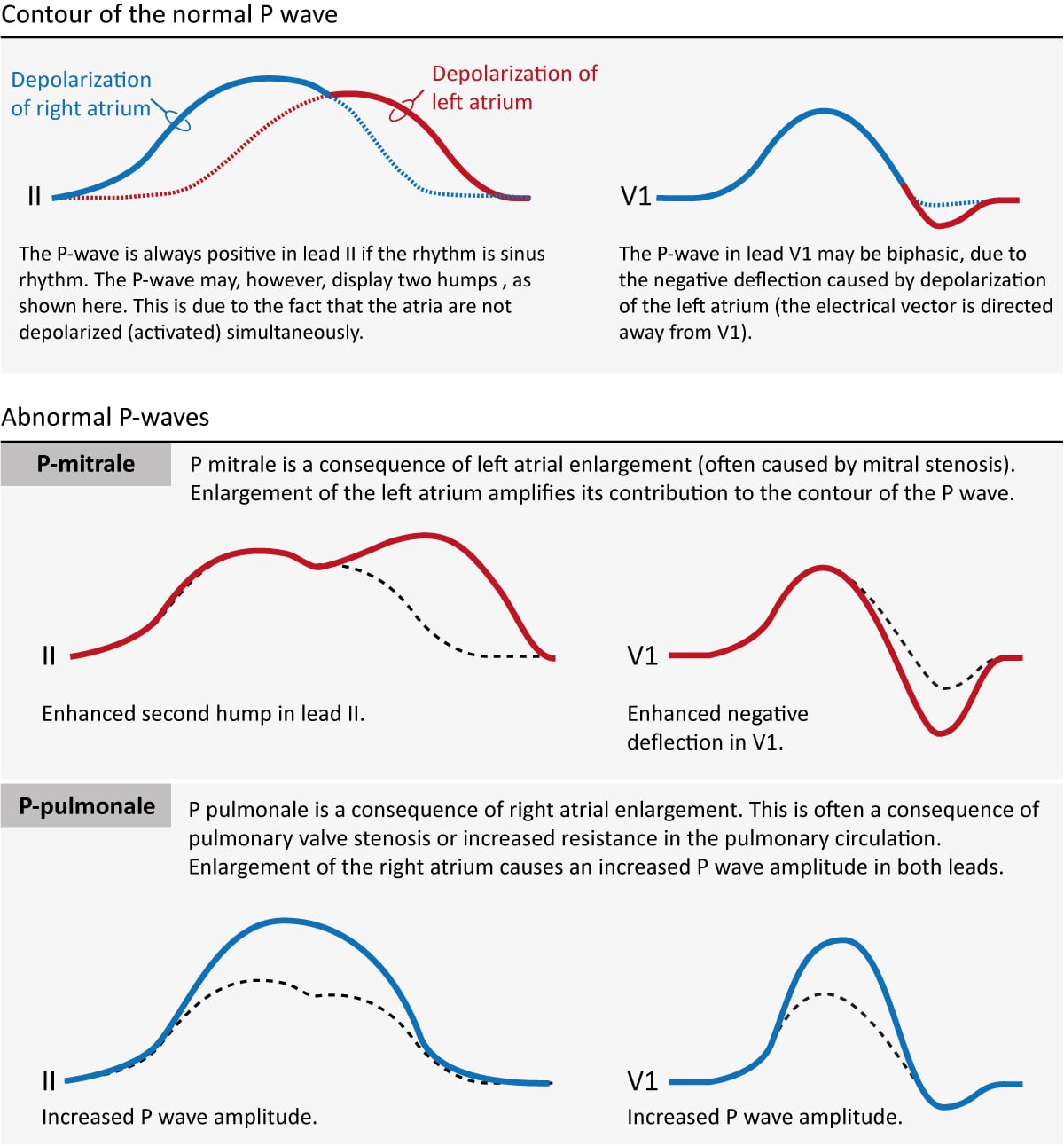 Figure 3. The contour of the normal and abnormal P-wave (P pulmonale and P mitrale).