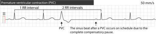 Premature ventricular contractions (premature ventricular complex ...