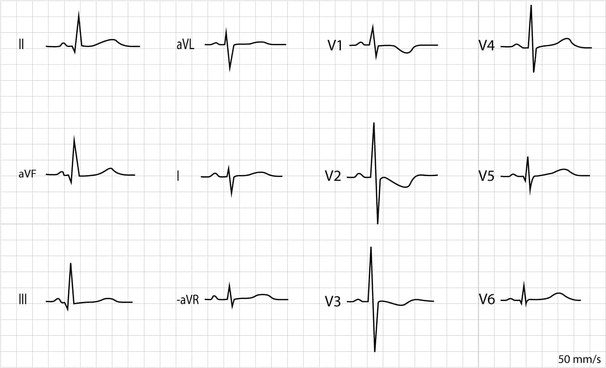 Figure 3. ECG recorded in a 8 days old female. The electrical axis is deviated rightwards (negative QRS i lead I and positive QRS in lead II). The R-waves are prominent in leads V1, V2 and V3. There are negative T-waves in V1–V3, which are also normal. There are Q-waves in inferior limb leads (II, aVF and III) and lateral chest leads (V5, V6).