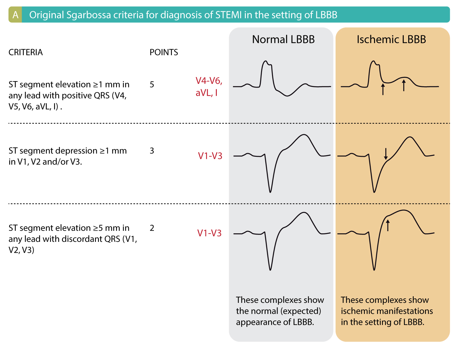 Figure 1A. ECG criteria (Sgarbossa criteria) for acute STEMI in the setting of LBBB. Each criteria gives 2 to 5 points. Studies show that a cut-off of ≥3 points yields a sensitivity of 20–36% and specificity of 90–98% for acute STEMI in the setting of LBBB.
