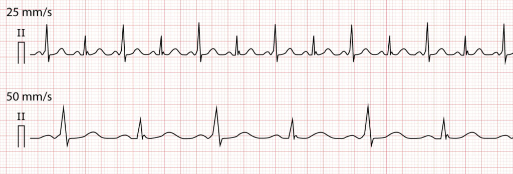 Figure 6. ECG displaying each and every beat conducted through an accessory pathway, which results in variations in QRS-amplitude.