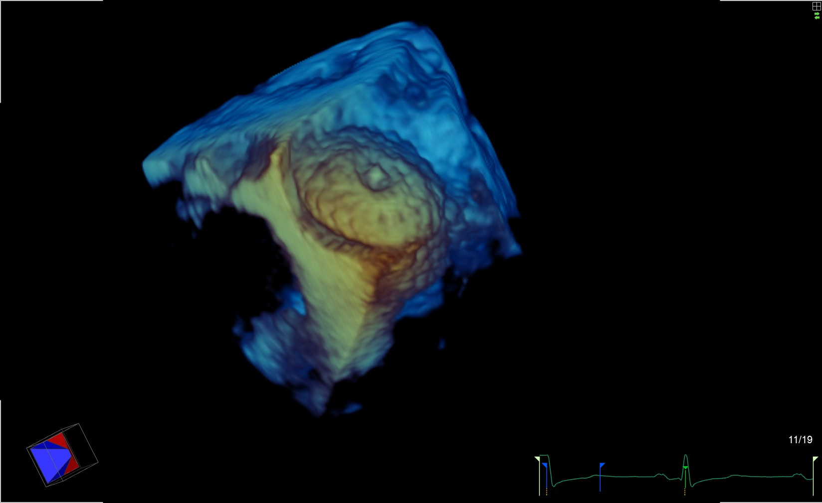 echocardiography