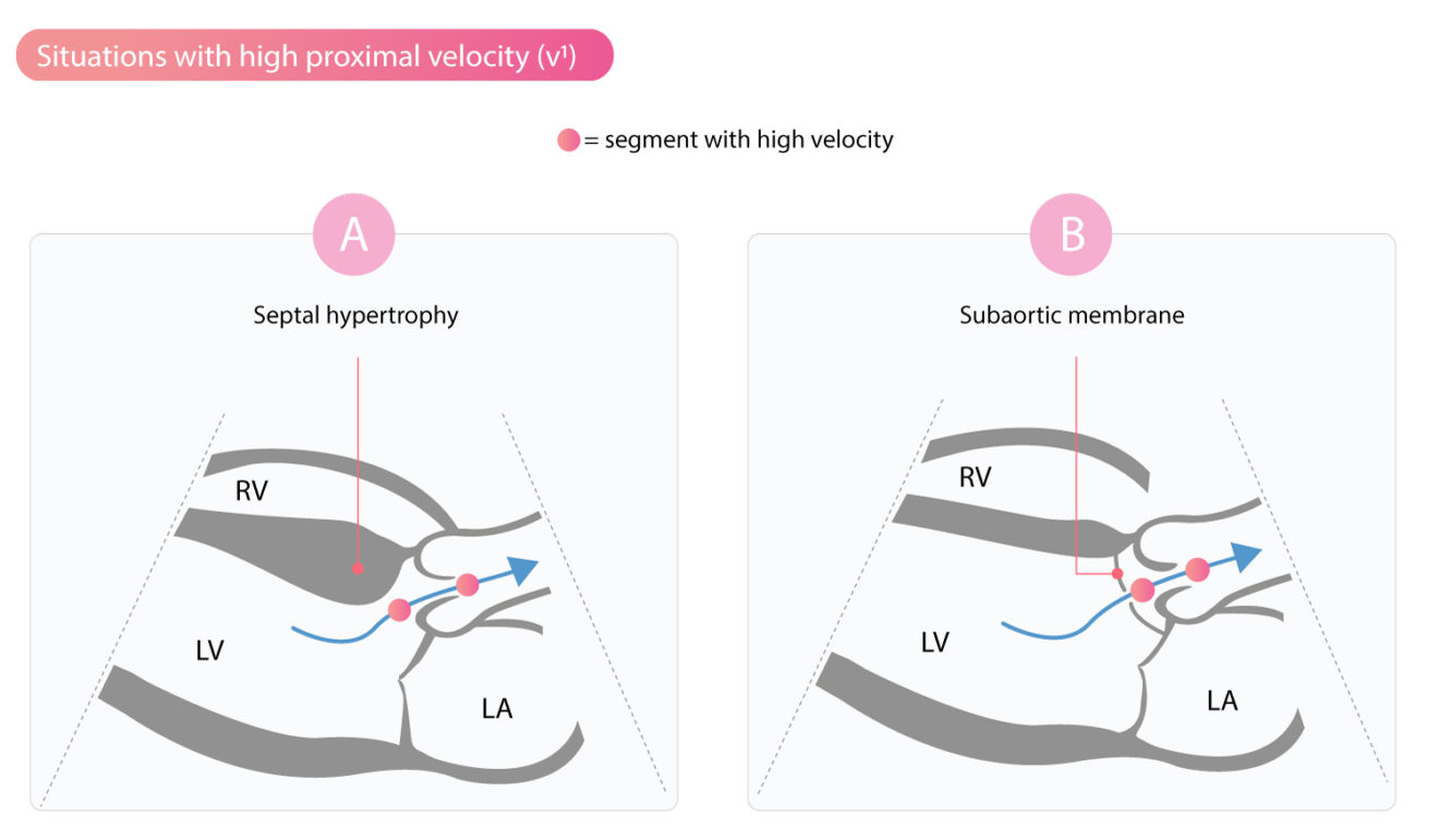 Bernoulli equation principle ultrasound doppler pressure gradient Bernoulli equation principle ultrasound doppler pressure gradient