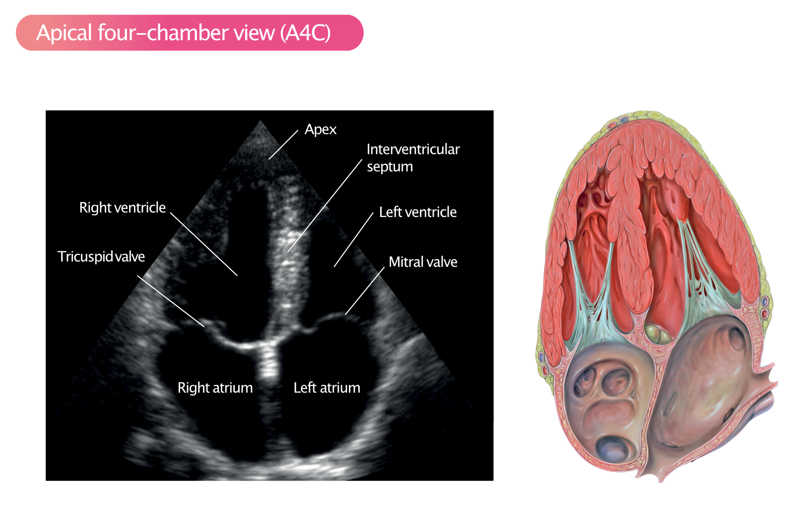 Figure 12. Apical four-chamber view (A4C).