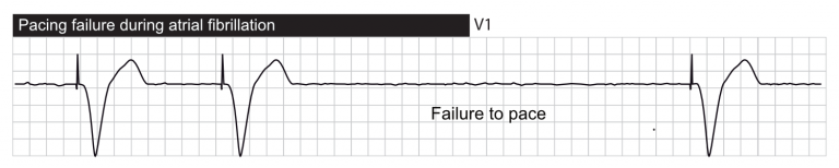 Assessment Of Pacemaker Malfunction Assessment Of Pacemaker Malfunction