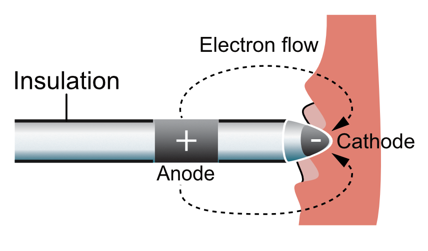 Figure 2. Pacemaker lead.