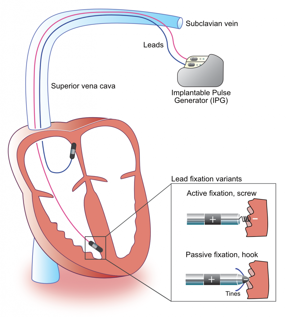 Figure 1. Components of a pacemaker.