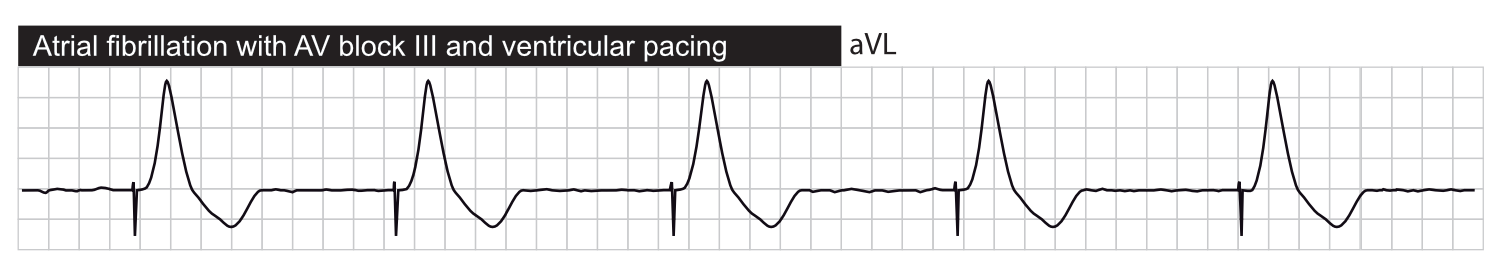 Atrial fibrillation with third-degree AV block, with ventricular pacing.