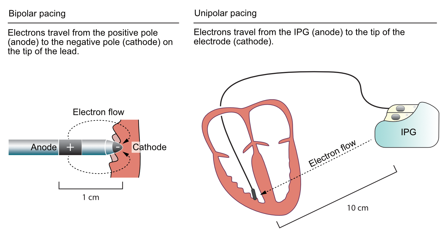 Figure 3. Unipolar vs. bipolar pacing.