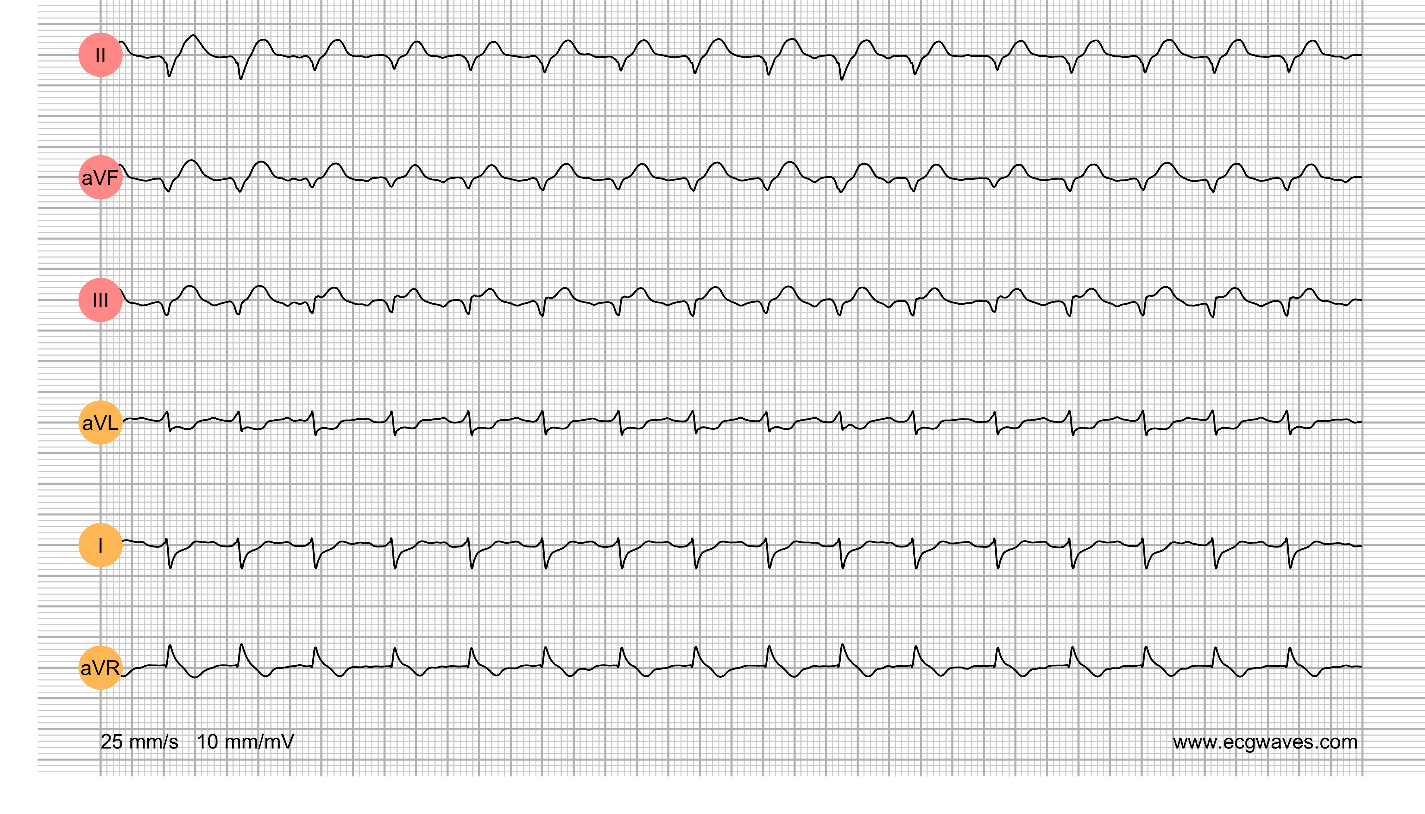 ECG Test (Quiz) Library: Question 1