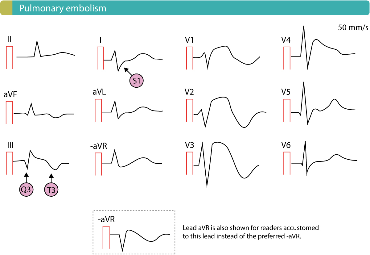 Pulmonary embolism with ST-segment elevations in right sided chest leads.